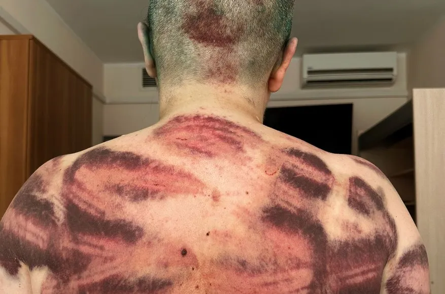 Fractures, bruises, and traumatic brain injury: Moscow clinic examines journalist Elena Milashina, victim of July 4 assault in Chechnya